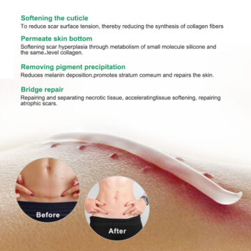 Aliver Reduce and Repair Cream for Scar Remove Treatment