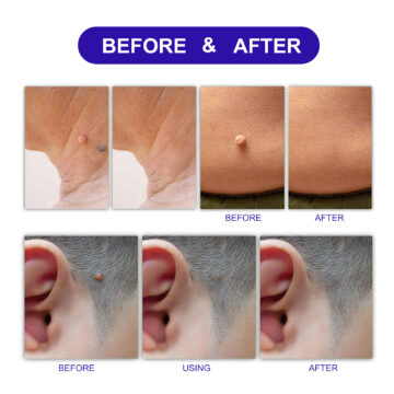 Aliver Skin Tag Remover Patches for Body Face 180 counts